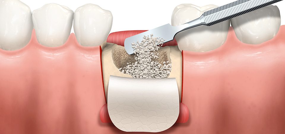 Наращивание кости зубов