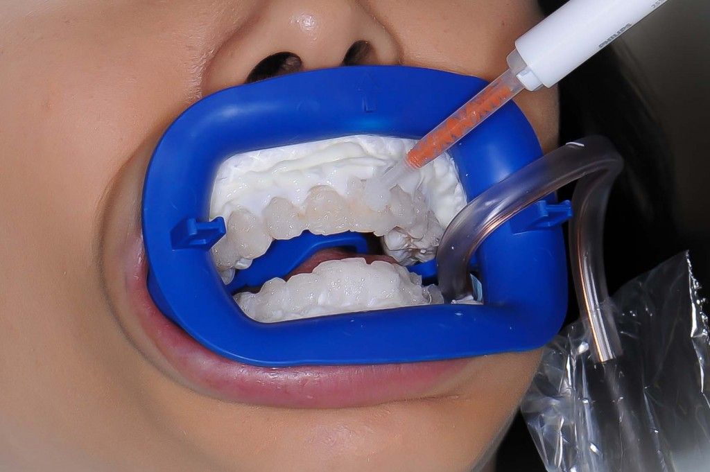 методы витального отбеливания зуба