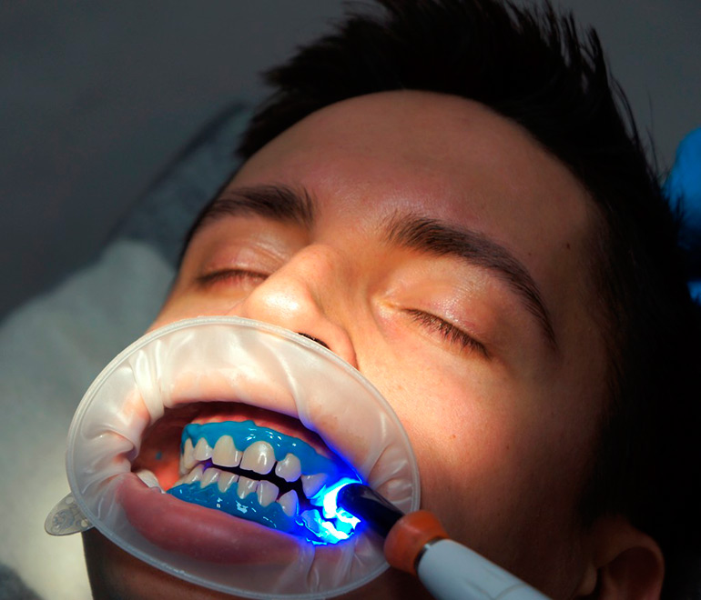 лазер отбеливание зубы