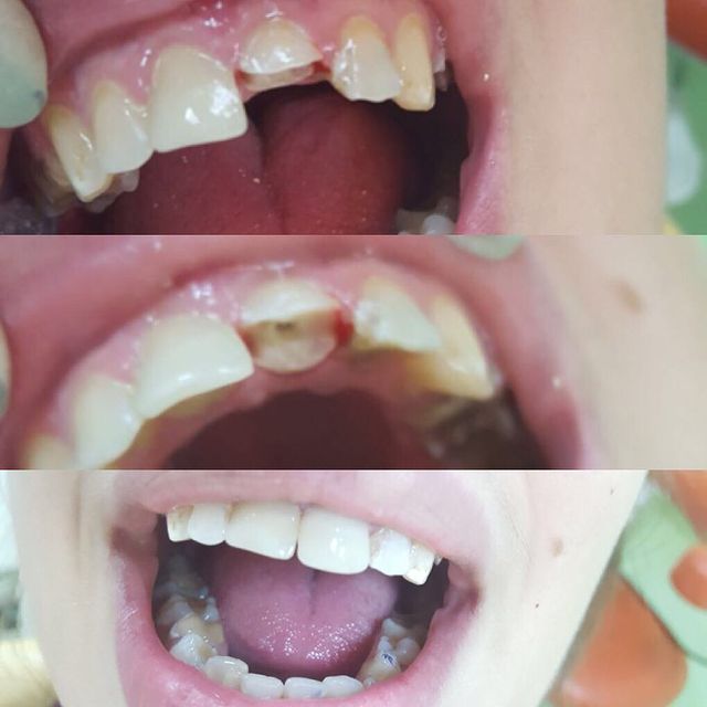Восстановление зуба композитным виниром