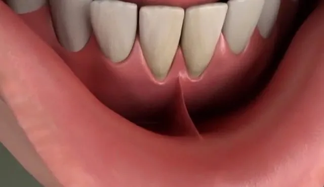 Короткая уздечка губы